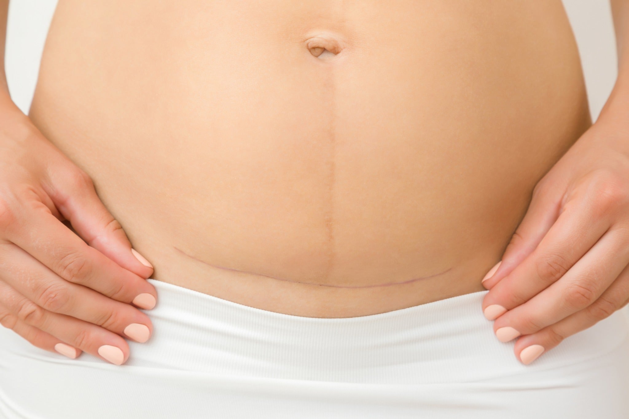 Understanding and Honoring the Cesarean Section Journey - bökee