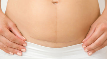 Understanding and Honoring the Cesarean Section Journey - bökee